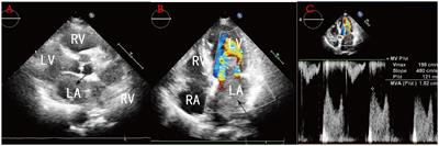 A case of left atrial intimal sarcoma with rhabdomyosarcoma differentiation: a case report and literature review